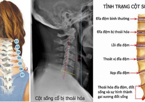 Thoái hoá khớp gây bệnh ở cột sống cổ