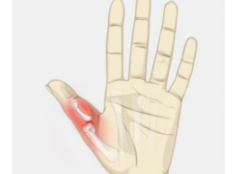 Điều trị đau khớp ngón tay cái