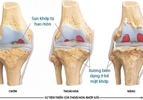 Cảnh báo ngày càng nhiều người trẻ mắc bệnh thoái hóa khớp