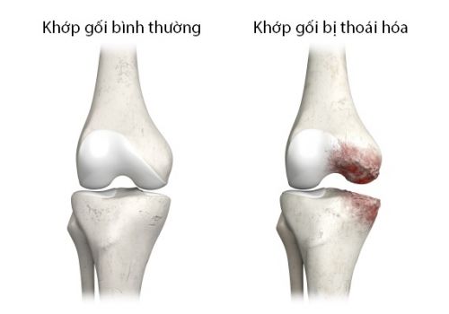 Đau nhức xương khớp do thoái hoá khớp