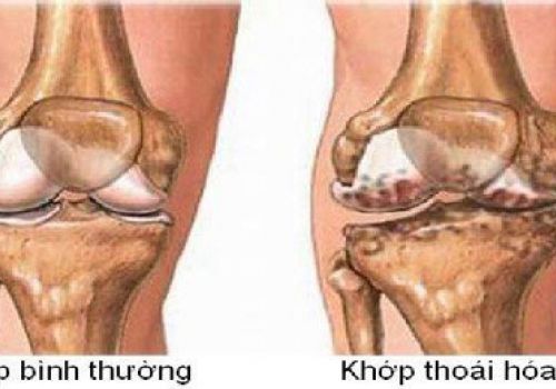 Thoái hóa khớp gối: Nỗi ám ảnh của người cao tuổi