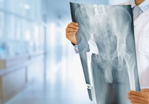 THOÁI HÓA KHỚP HÁNG: NGUYÊN NHÂN, TRIỆU CHỨNG, ĐIỀU TRỊ, PHÒNG NGỪA