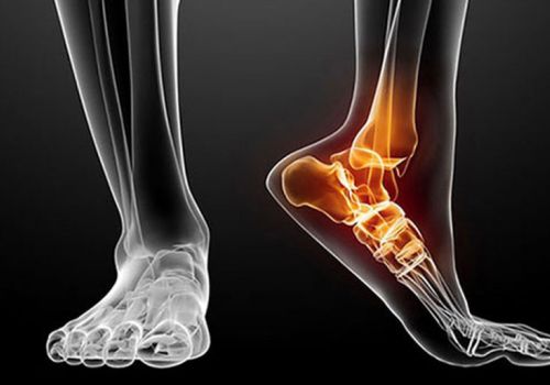 Thoái hoá khớp cổ chân