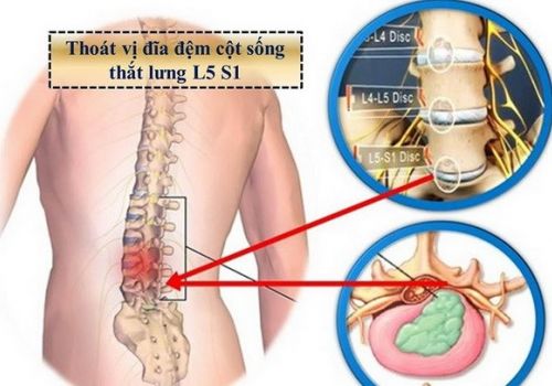 Bài thuốc đông y và cách xoa bóp chữa đau lưng
