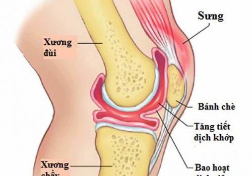 VIÊM MÀNG HOẠT DỊCH: NGUYÊN NHÂN, TRIỆU CHỨNG VÀ CÁCH ĐIỀU TRỊ