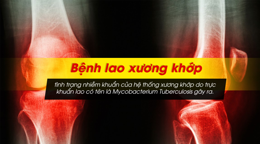 benh-lao-xuong-khop