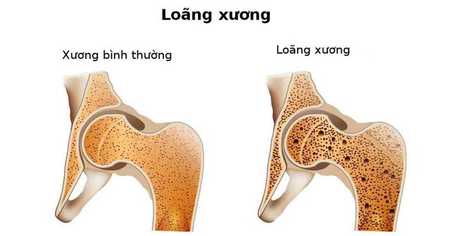 loang-xuong-1-16644560181701338639609