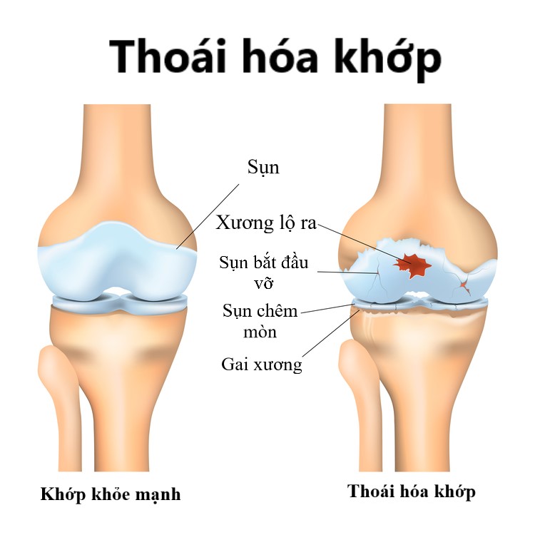 thoai-hoa-khop