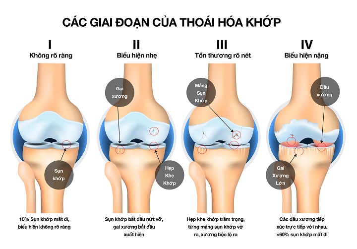 3838-thoai-hoa-khop6