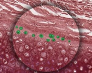 nguyên-bào-sụn-300x240